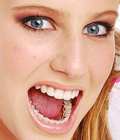 Close up of young woman smiling wide with lingual braces