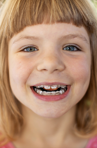 Young girl grinning with braces