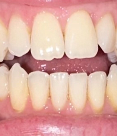 Close up of upper and lower row of teeth after orthognathic surgery in Houston