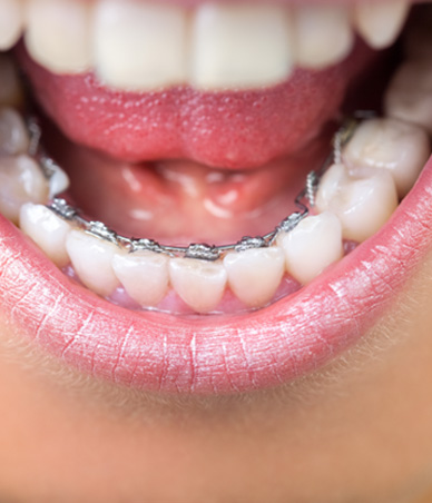Lingual braces on woman’s lower dental arch