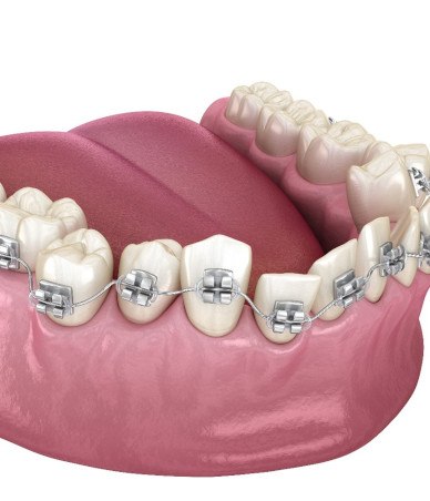 Illustration of traditional braces on lower dental arch