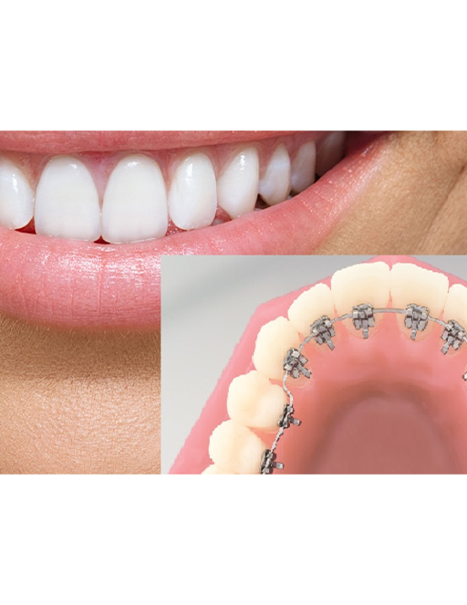 Orthodontics – Braces & Lingual Braces (invisible) - Advanced