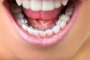 Close-up of woman’s lingual braces